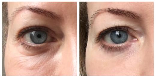 A Wrinkle-Shrinking Eye Cream That Really Works: My Perfect Eyes